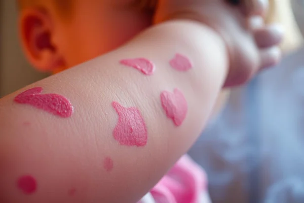 Allergie Hautausschlag Kinder